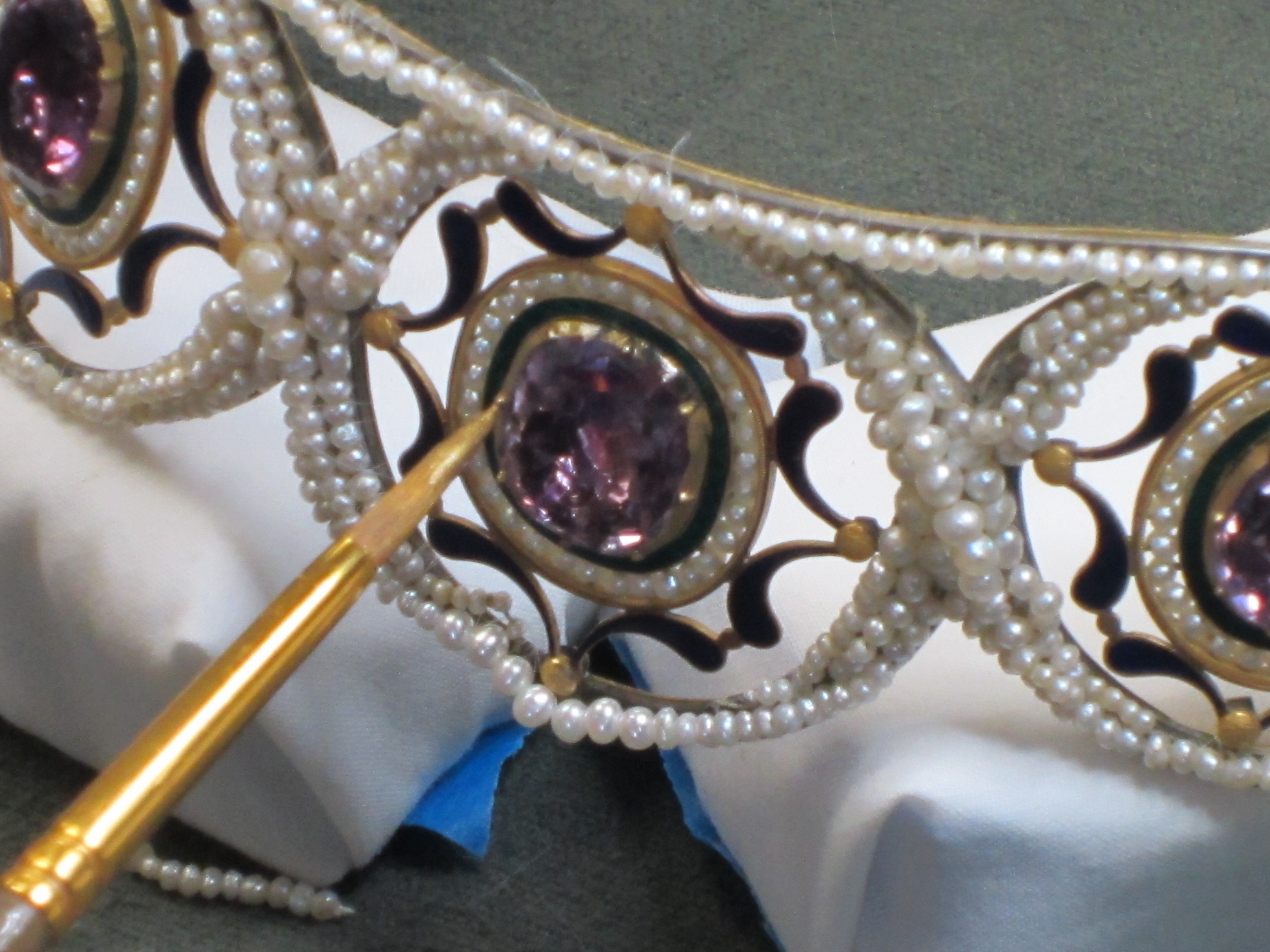 During Treatment- Inpainting of Losses to Enamel